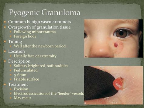 PPT - Hemangiomas and Vascular Malformations PowerPoint Presentation ...