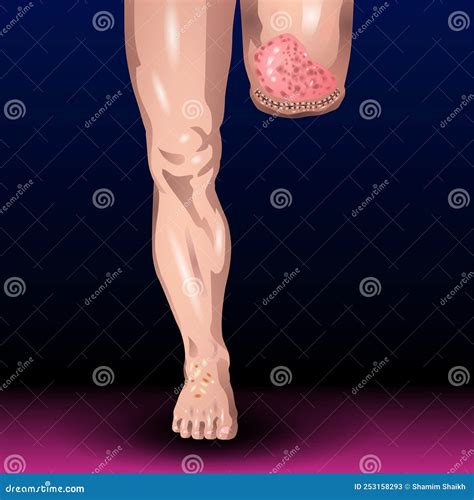 Leg Amputation - Healthcare - Science - Medical Treatment - Organ Stock Illustration ...