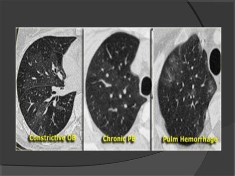 Hrct chest technique and interpretation