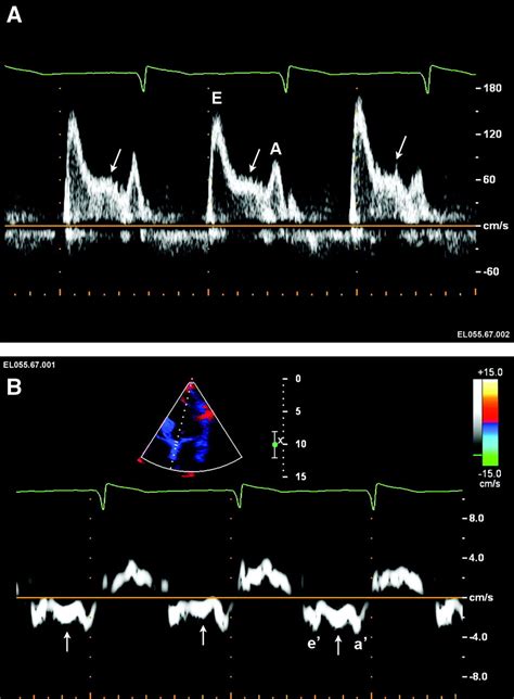 Established and Novel Clinical Applications of Diastolic Function Assessment by Echocardiography ...