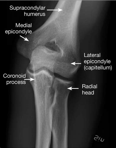 Radial Head Fracture Classification