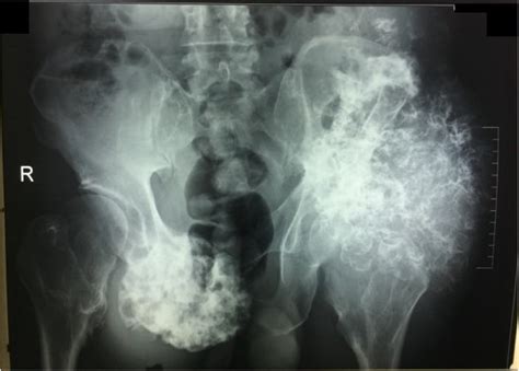 A plain radiograph revealed popcorn calcification. | Download ...