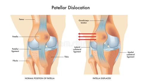 What is Knee Cap Dislocation (Patella Dislocation)? - Turkey Istanbul Medical