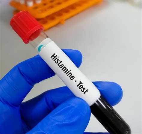 Premium Photo | Histamine test. a test can help doctors determine if a severe allergic reaction ...