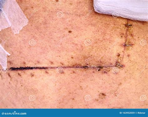 Fresh Postoperative Scar Sewn with Silver Thread Stock Image - Image of health, medic: 163952059