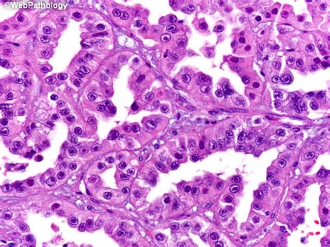 High Quality Pathology Images of Renal Cell Carcinoma | PracticeUpdate