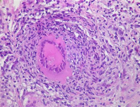 Histology for the USMLE: How to Identify a Granuloma