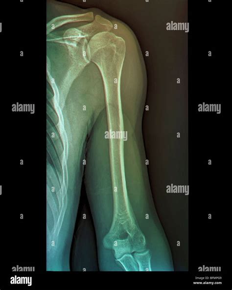 Normal shoulder joint, X-ray Stock Photo - Alamy