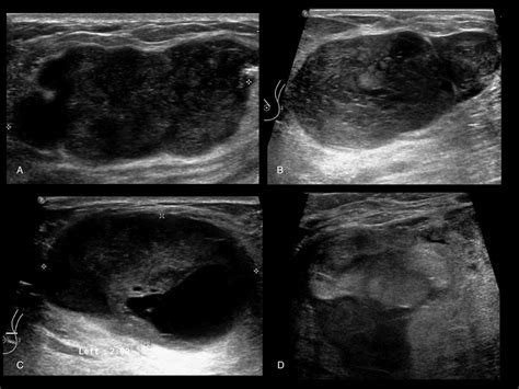 Benign Tumor