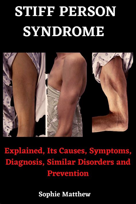 Stiff Person Syndrome Book: Explained, Its Causes, Symptoms, Diagnosis ...