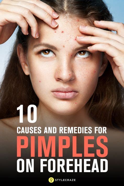 How To Get Rid Of Pimples On Forehead | Pimples on forehead, Pimples remedies, Home remedies for ...