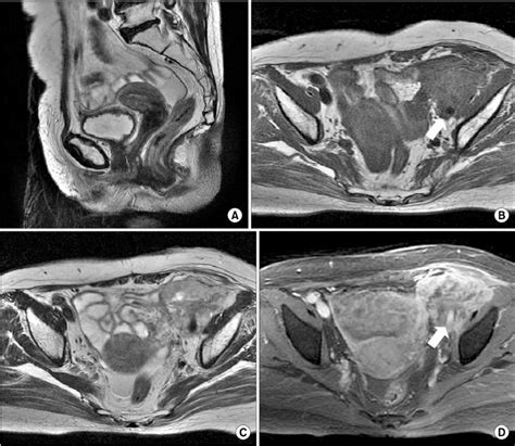 Normal Mri Of Pelvis