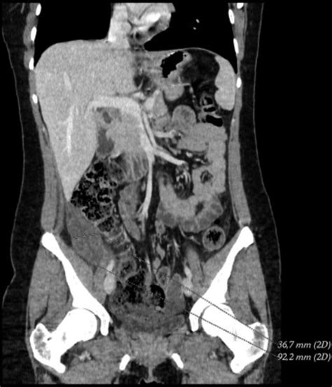 Tomografía computada abdominal urgente con contraste intravenoso: con...