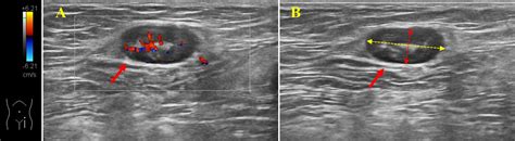 Frontiers | Detection of inguinal lymph nodes is promising for the ...