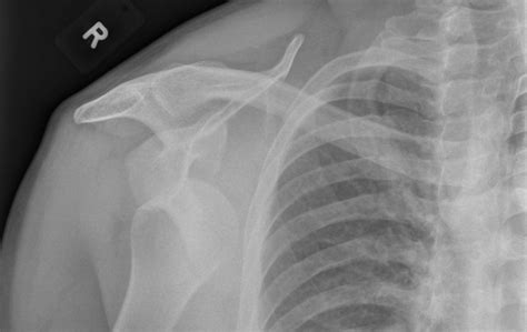 Glenohumeral Dislocation – Anterior and Posterior – Undergraduate ...