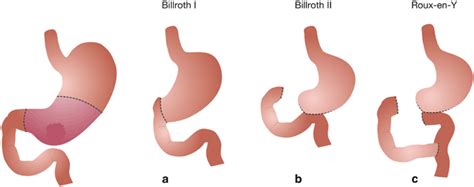 Methods of Reconstruction—BI, BII, Roux-en-Y, Jejunal Interposition, Proximal Gastrectomy and ...