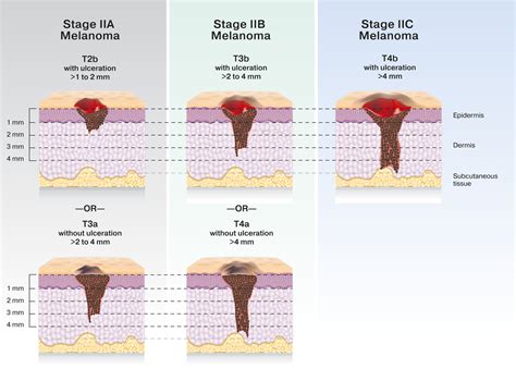 Melanoma Stage 4