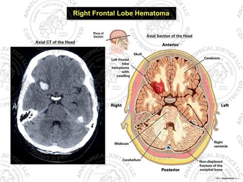 Right Posterior Frontal Lobe