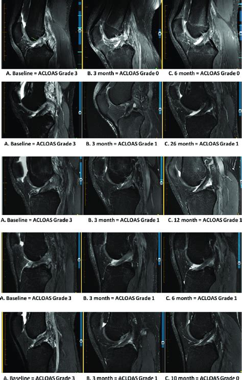 MRI images demonstrating MRI evidence of ACL healing for five ...