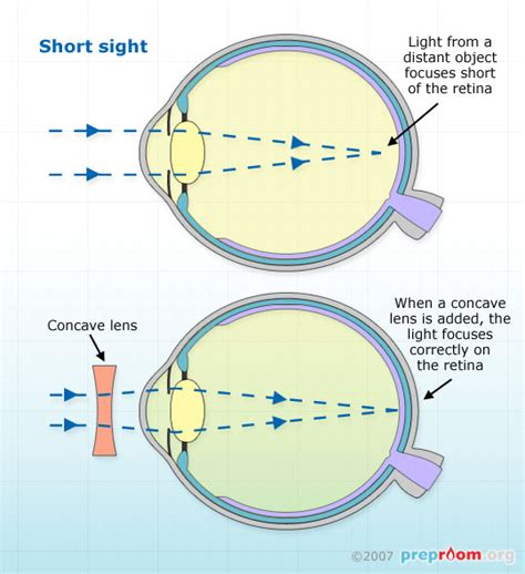 how do glasses work for long sightedness - Jefferey Lear