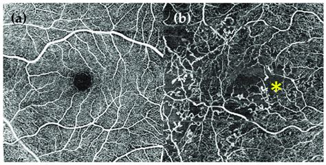 Optical coherence tomography angiography (OCT-A) of 6 × 6 mm. (a ...