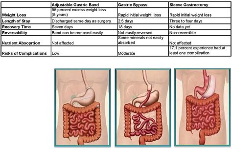 What are the Three Different Types of Weight Loss Surgery?