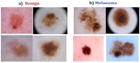 Benign Tumor Skin