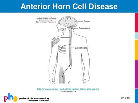 I don't know what to write my paper about Anterior horn disease