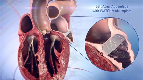 Left Atrial Appendage Closure | Heart Care | Intermountain Healthcare