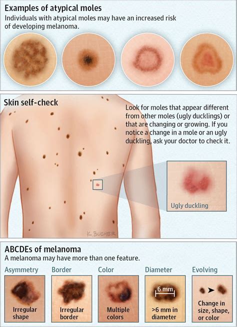 Atypical Moles JAMA Dermatol. 2016;152(12):1408. doi:10.1001 ...