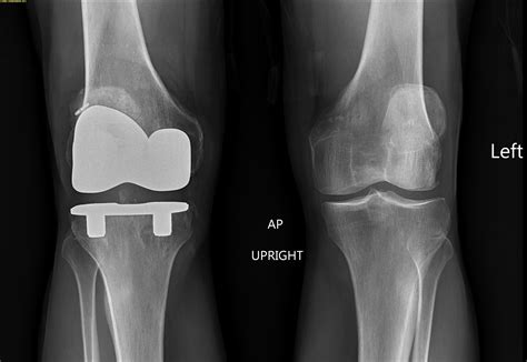 My New Knee: Running Again after a Total Knee Replacement | Uphill Athlete