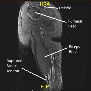 Case Study: Distal Bicep Rupture Management in 38 yr. Old Female