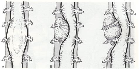 Spinal cord tumor