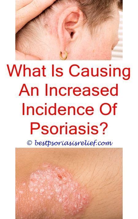 #biologicsforpsoriasis mild scalp psoriasis pictures - psoriasis and menstrual cycle.# ...