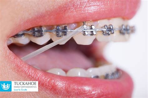 Orthodontic Rubber Bands Are an Important Part of Treatment