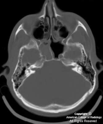 Neuroradiology On the Net: Temporal bone fracture