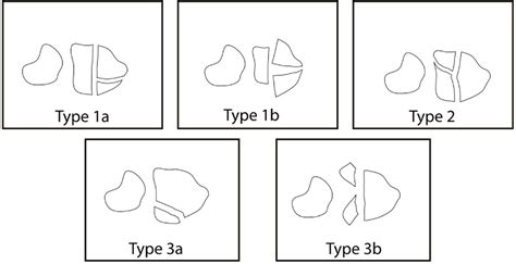 Table 1 from Displaced sigmoid notch fracture and higher patient age are Displaced sigmoid notch ...