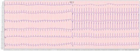 Examples of paroxysmal supraventricular tachycardia (PSVT) | ECG Library