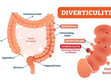 diverticulosis Archives | The Oldish®