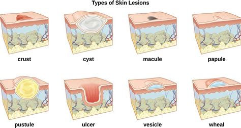 A skin lesion is a part of the skin that has an abnormal growth or appearance compared to the ...