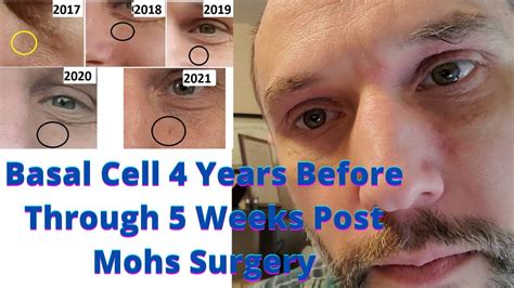 Mohs Surgery and Basal Cell 4 Years Before To 5 Weeks After Surgery - YouTube