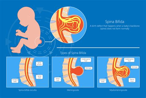 Spina Bifida | Obstetrics and Gynecology & Maternal Fetal Surgery located in Park Ridge, IL ...