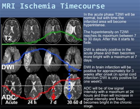 Infarction Timeline in T2, DWI and ADC | Radiology imaging, Medical ...