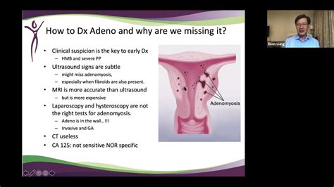 Adenomyosis: Diagnosis and Treatment Options with Dr. Eisen Liang ...