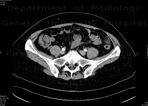 Radiology case: Epiploic appendagitis