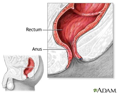 Hemorrhoid surgery | UF Health, University of Florida Health