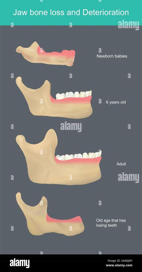 Jaw bone loss and Deterioration. When born, the body needs calcium to ...