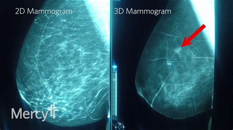 Biology 360 Group Project - How is a Mammogram done?