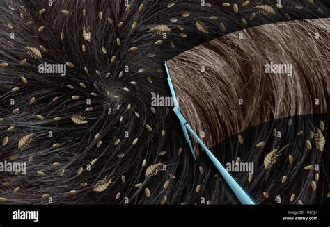 Removing lice as a medical concept with louse insects on human hair Stock Photo, Royalty Free ...