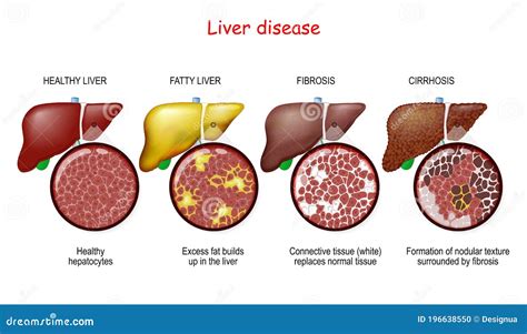 Stages Of Liver Damage. The First Symptoms Of Liver Problems Are Abdominal Pain, Swollen Belly ...